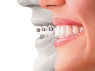 The image is a digital illustration showing a smiling woman's face with a dental implant, set against a background that features a man's face with a missing tooth and the silhouette of a smiling person.