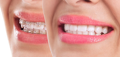 The image shows a close-up of a woman's smiling face, with her teeth and lips visible, against a plain background.