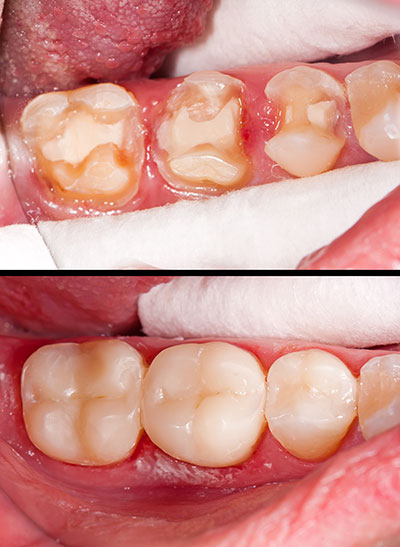 The image shows a close-up view of a person's mouth with teeth that appear to be in poor condition, possibly due to decay or gum disease. The teeth are discolored and some are missing, indicating the need for dental care.