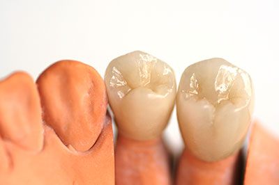 The image shows a set of dental implants, which are artificial tooth roots that are surgically placed into the jawbone to support replacement teeth.