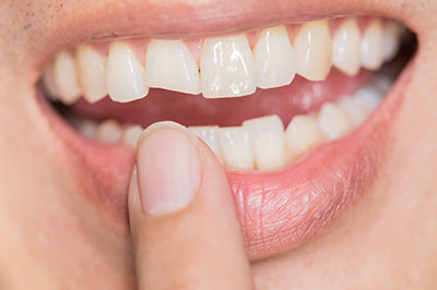 The image shows a close-up of a person's teeth with a focus on dental care, possibly for advertising or educational purposes.