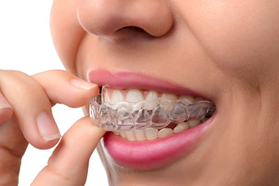 An adult wearing a full set of clear dental braces with the brackets attached to their teeth, holding a finger under their chin.