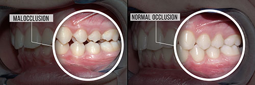 The image shows a side-by-side comparison of two photographs of a person's teeth, with the top photo depicting a normal set of teeth and the bottom photo showing teeth with signs of occlusion.