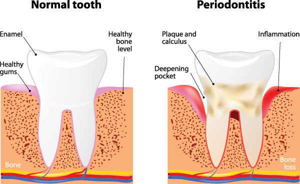 The image is a medical illustration showing the stages of gum disease progression from normal to periodontitis, with annotations indicating bone loss and inflammation.