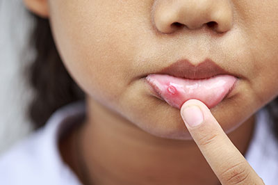 A young child with a pimple on their face, holding their finger to it.