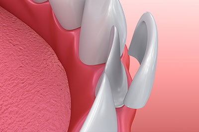 The image features a close-up view of a dental implant with multiple screws and a pink gum background.