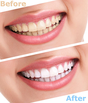 The image shows a side-by-side comparison of a person's teeth before and after dental treatment, with the treated teeth appearing whiter.