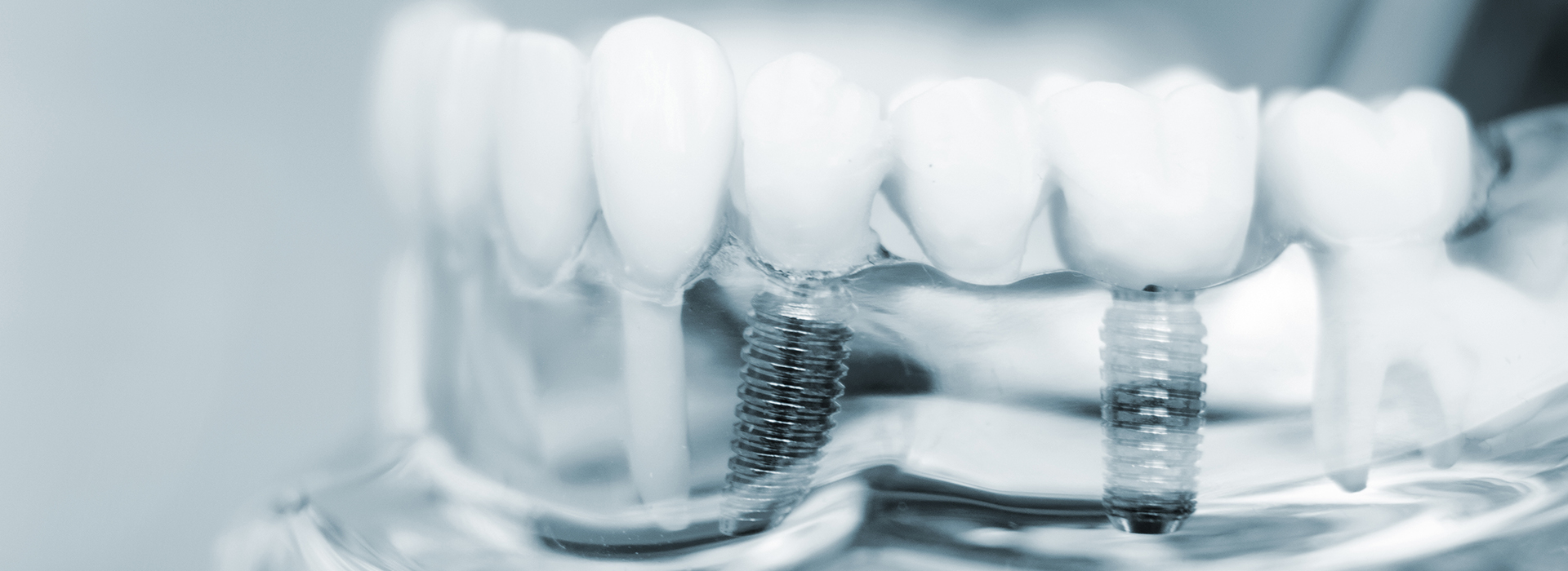 The image shows a close-up of a dental implant with screws and a transparent base, showcasing the components that are not visible when the implant is placed in a mouth.